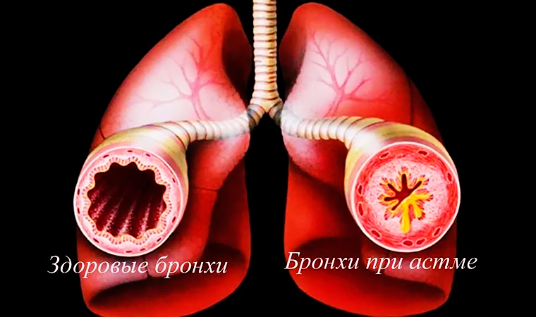 Бронхи при астме