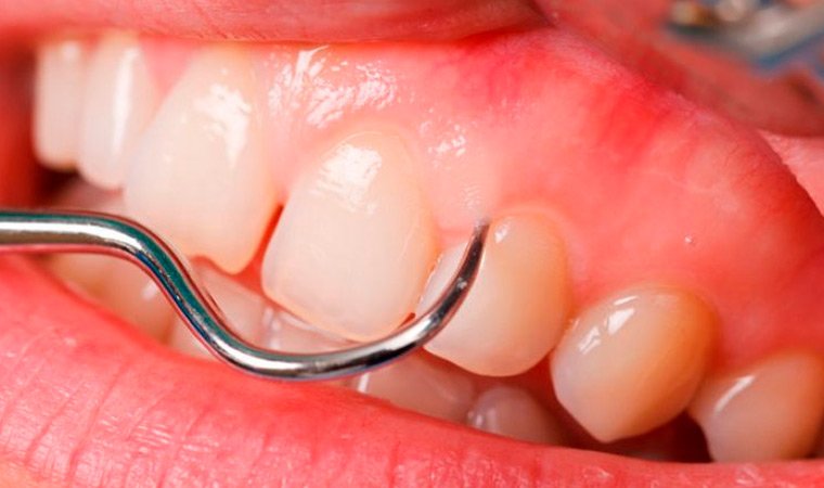 Что лечит парадонтолог