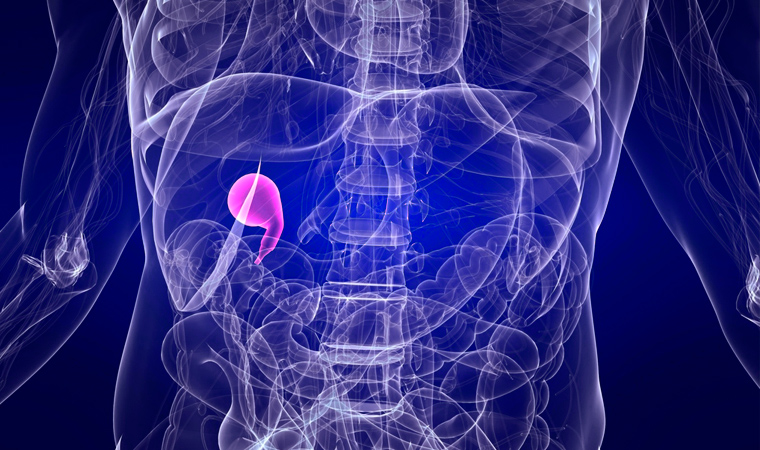 Холецистит