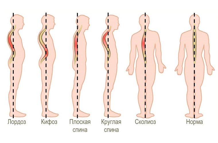 Искривление позвоночника
