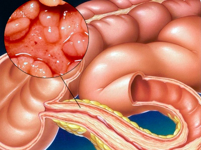 Как развивается болезнь Крона