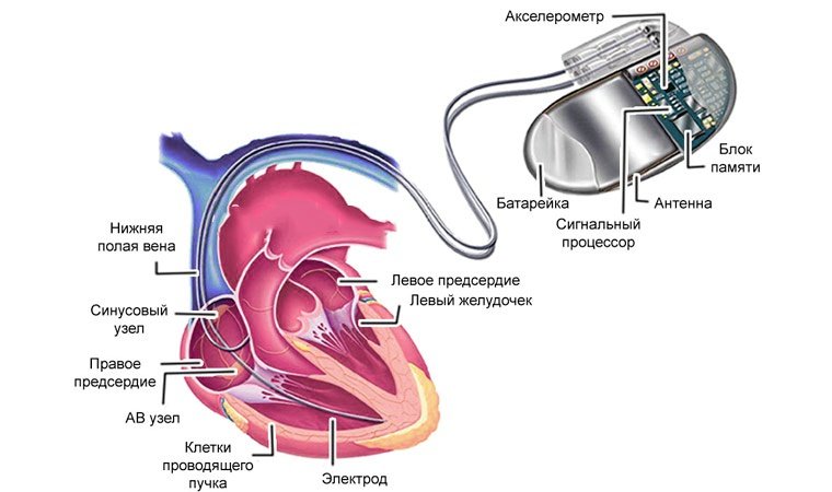 Кардиостимулятор