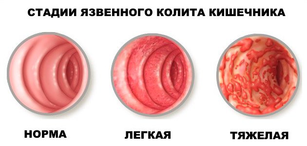 Колит