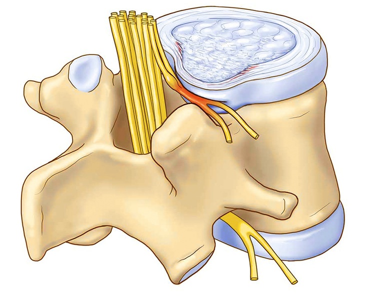Корешковый синдром