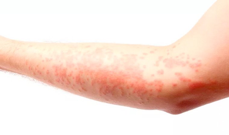 Крапивница