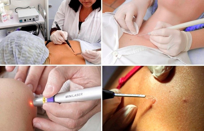 Лечение папиллом