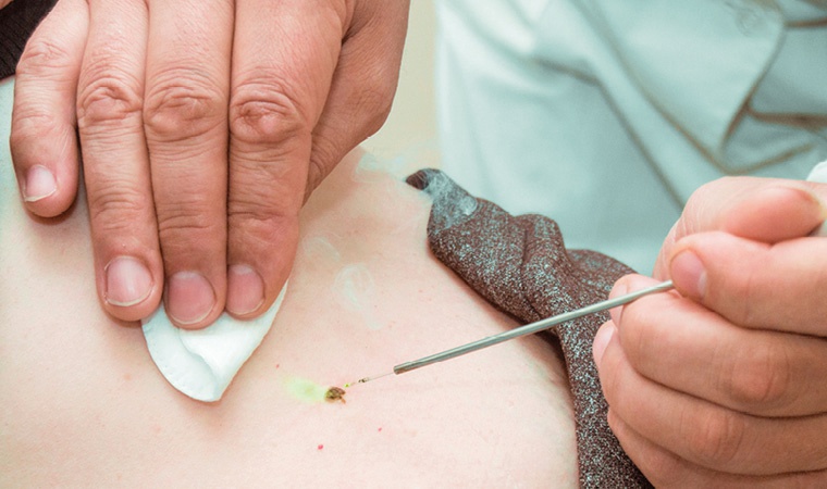 Лечение папиллом