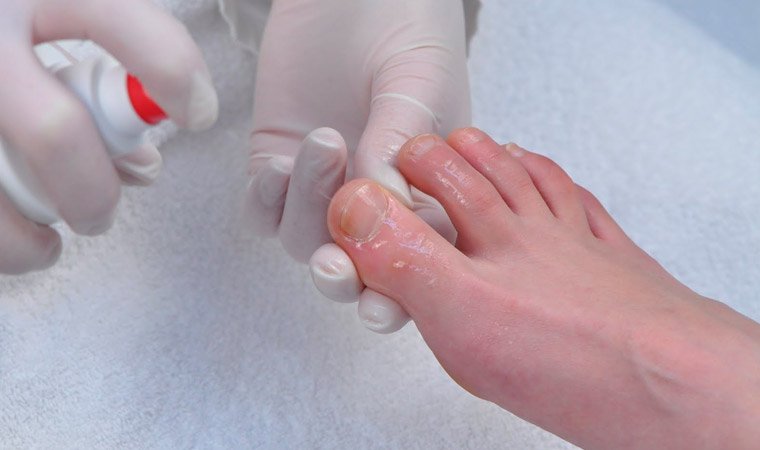 Методы лечения миколога