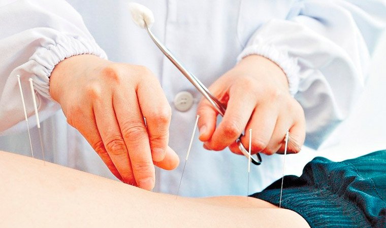 методы рефлексотерапии