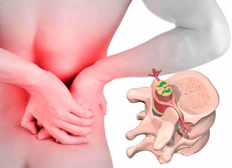 Межпозвонковые грыжи