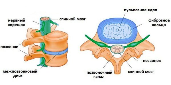 Межпозвоночная грыжа