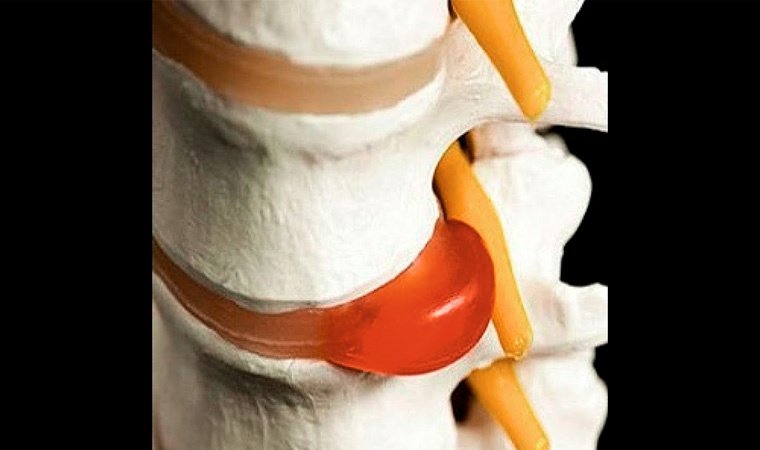 Межпозвоночная грыжа