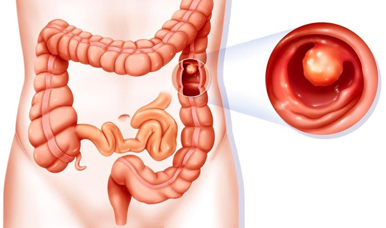 Новообразования в кишечнике