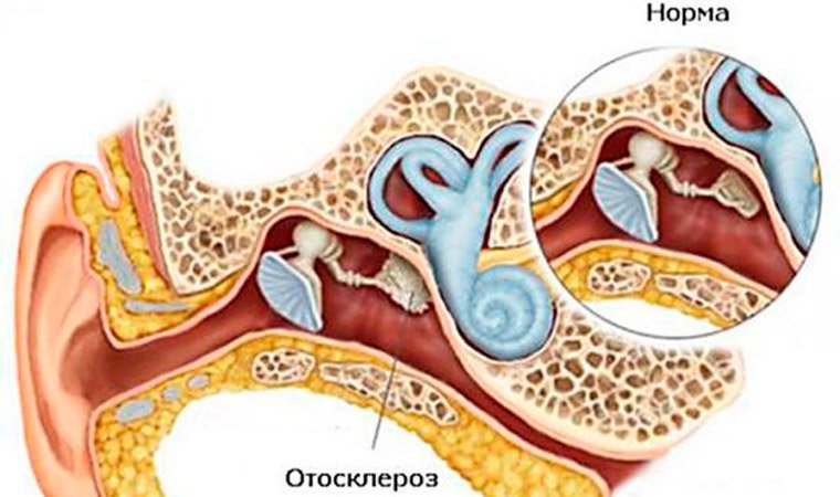Отосклероз