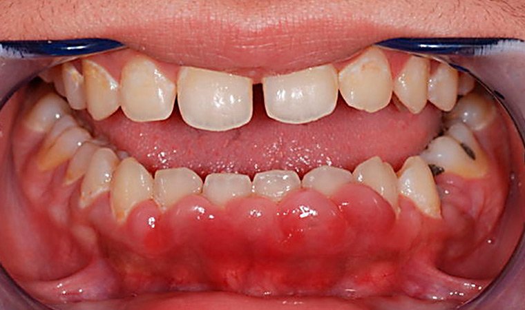 Парадонтомы