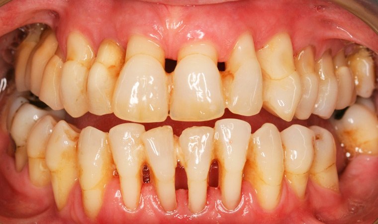 Парадонтоз