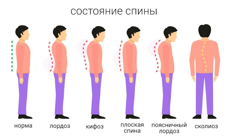 Патологии-спины