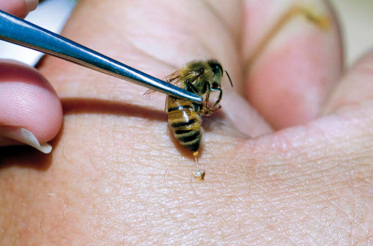 Пчелоужаление