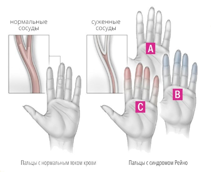Причины болезни Рейно