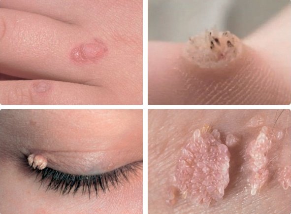 Виды папиллом