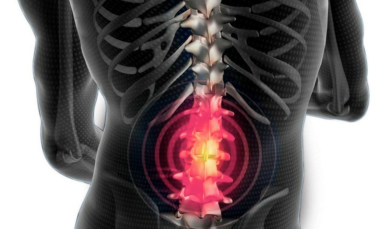 Причины появления межпозвоночной грыжи