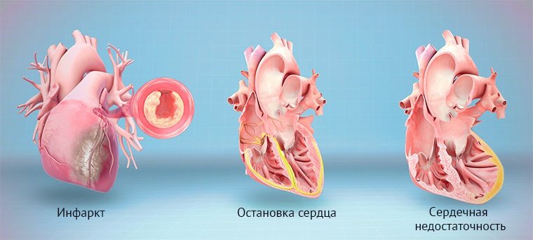 Проблемы с сердцем