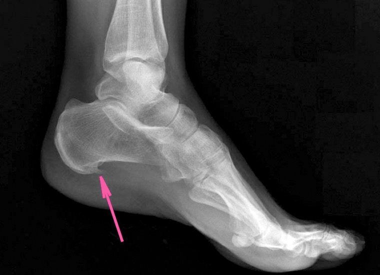 Пяточная шпора