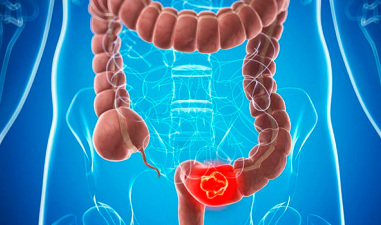 Рак кишечника