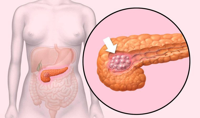 Рак поджелудочной железы