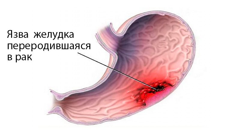 Рак желудка