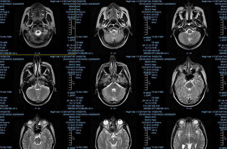 Расшифровка мрт