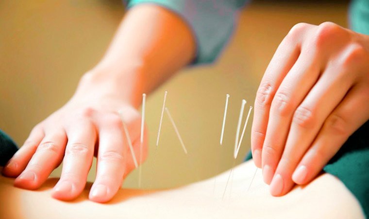 Рефлексотерапия