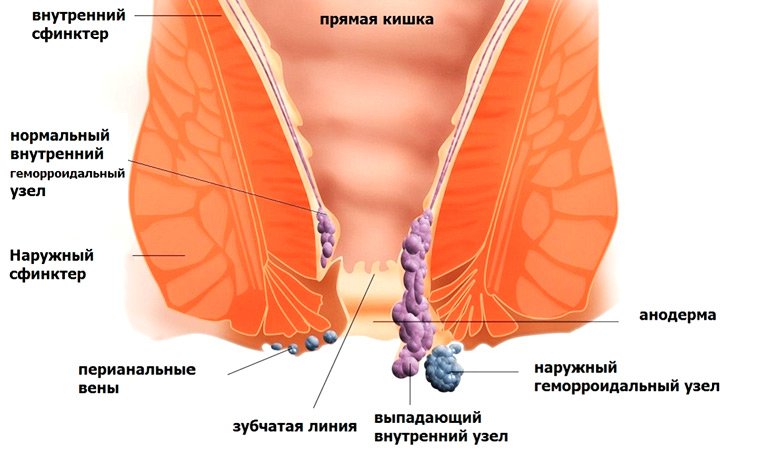 Симптомы геморроя