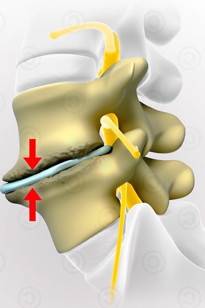 Спондилоартроз