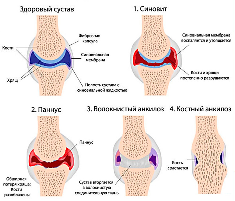 Стадии артрита