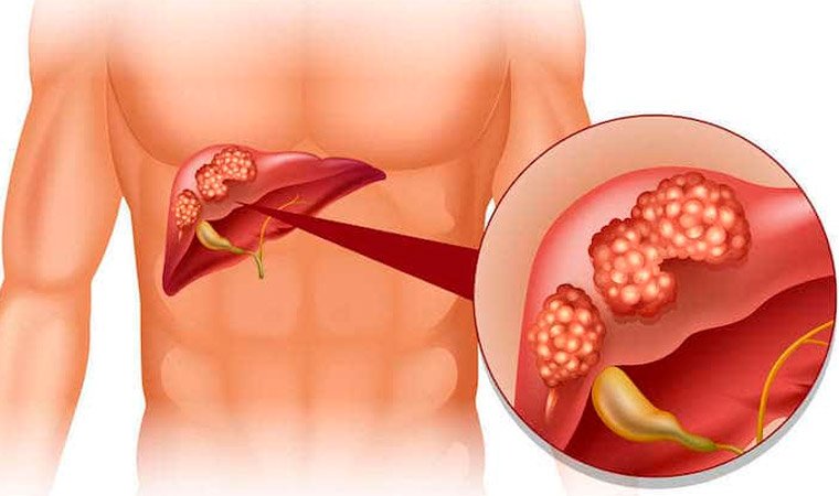 Цирроз печени