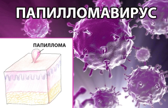 Вирус папилломы