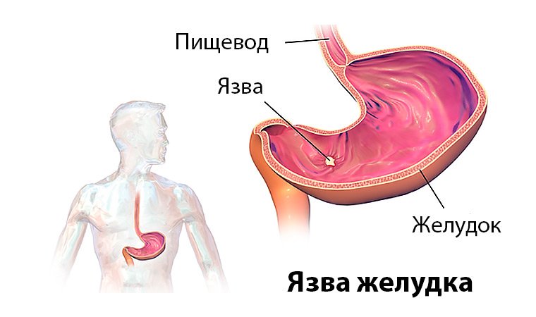 Язва желудка