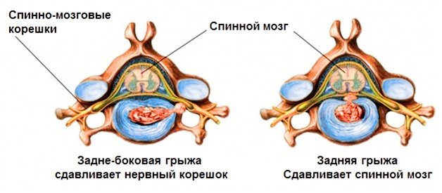 Виды межпозвонковых грыж по направлению выпадения