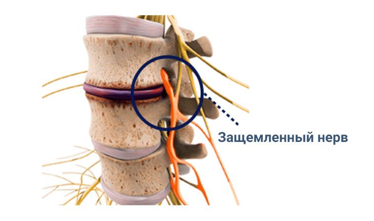 Защемленный-нерв