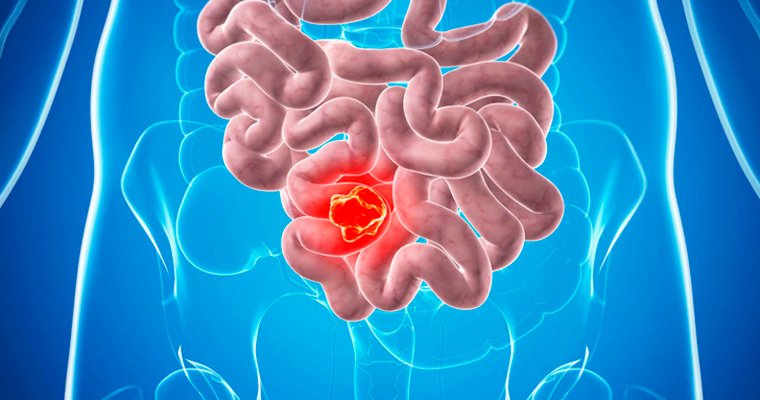 Злокачественные новообразования в кишечнике
