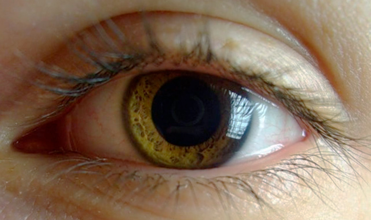 Зрачок при анизокории