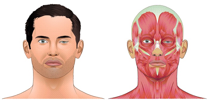 Как проявляется миастения Гравис