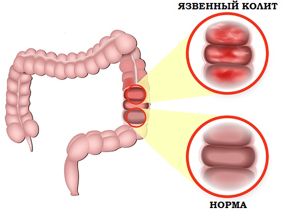 Язвенный колит у человека на фото