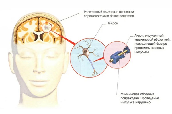 Рассеянный склероз