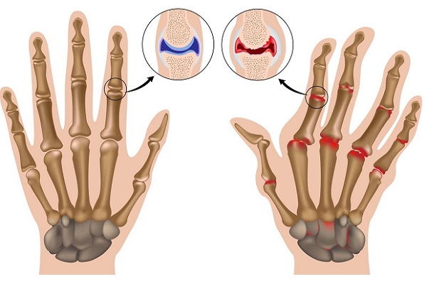 Ревматоидный артрит