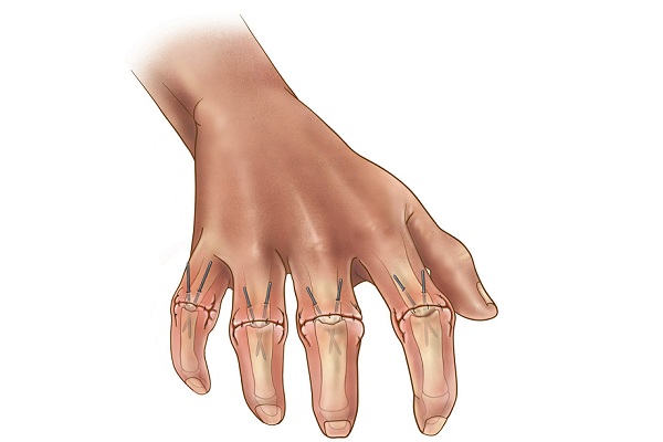 Одно из проявлений склеродермии