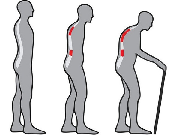 Болезнь Бехтерева