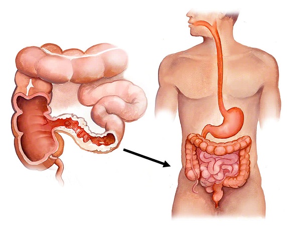 Болезнь Крона
