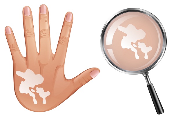 Витилиго на фото